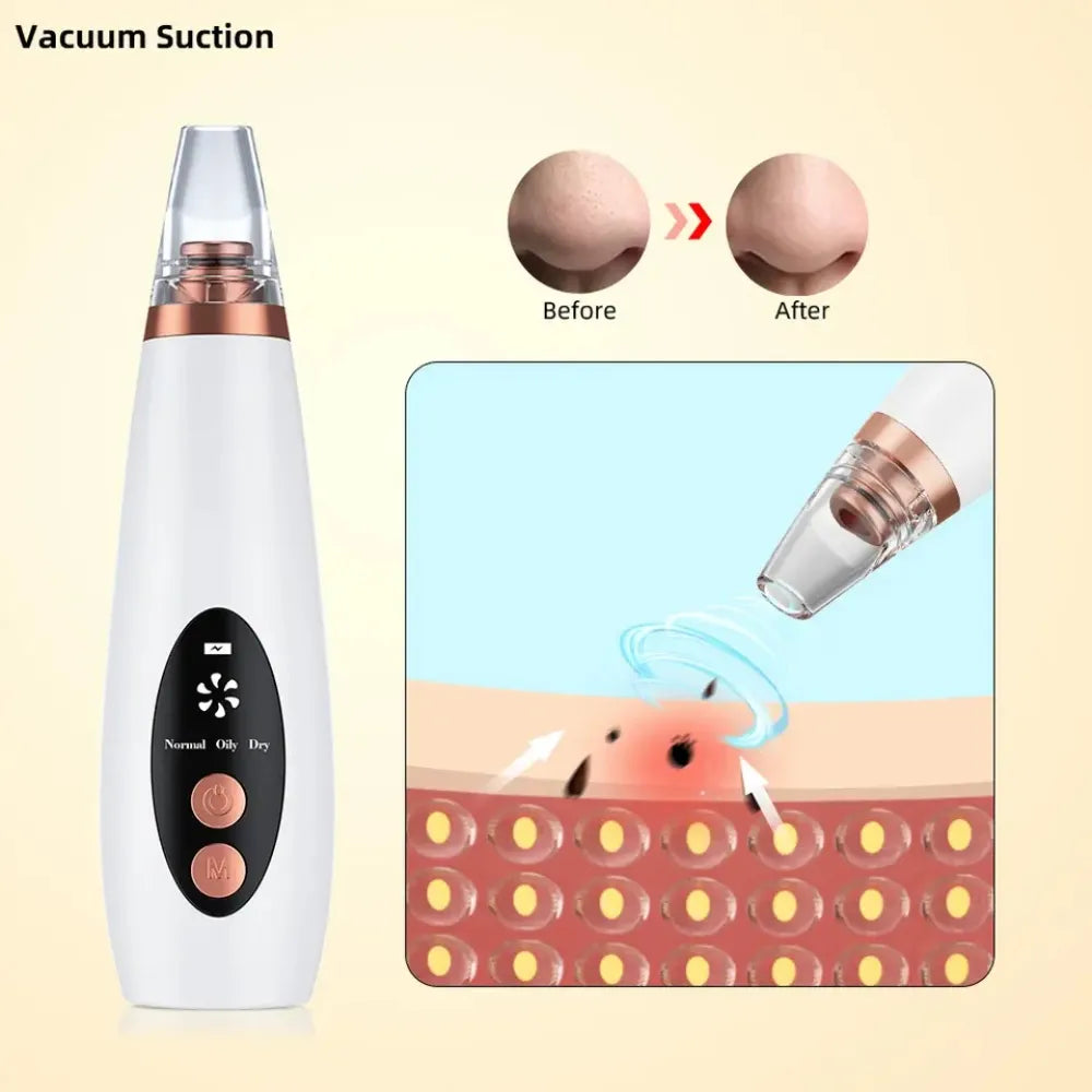 Before and after image showing visible reduction in blackheads and smoother skin after using the dermasuction machine.