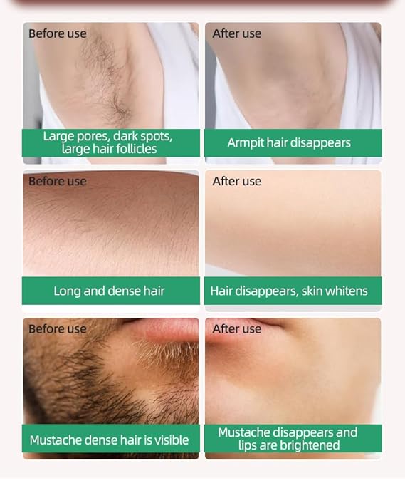 SEMINO Advanced Laser Hair Removal with Ice Cooling Technology(Green)